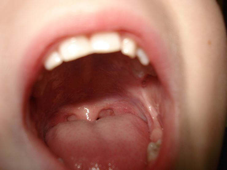 lingue denti bocca e alito cattivo 